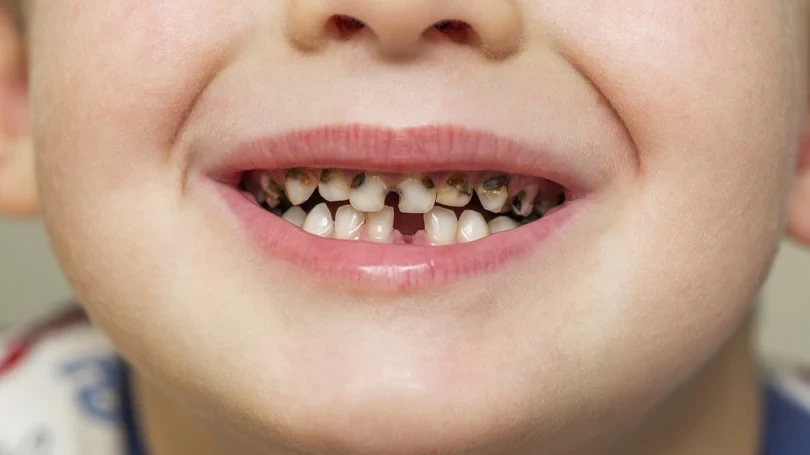 Sugary Diets Are Causing Rapid Dental Damage in Growing Kids